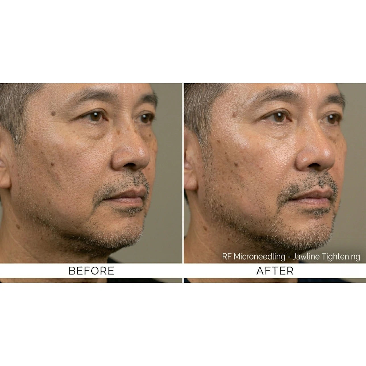FirmX RF: RF Microneedling