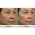 FirmX RF: RF Microneedling