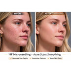 FirmX RF: RF Microneedling