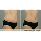 CryoShape: Cryolipolysis Machine