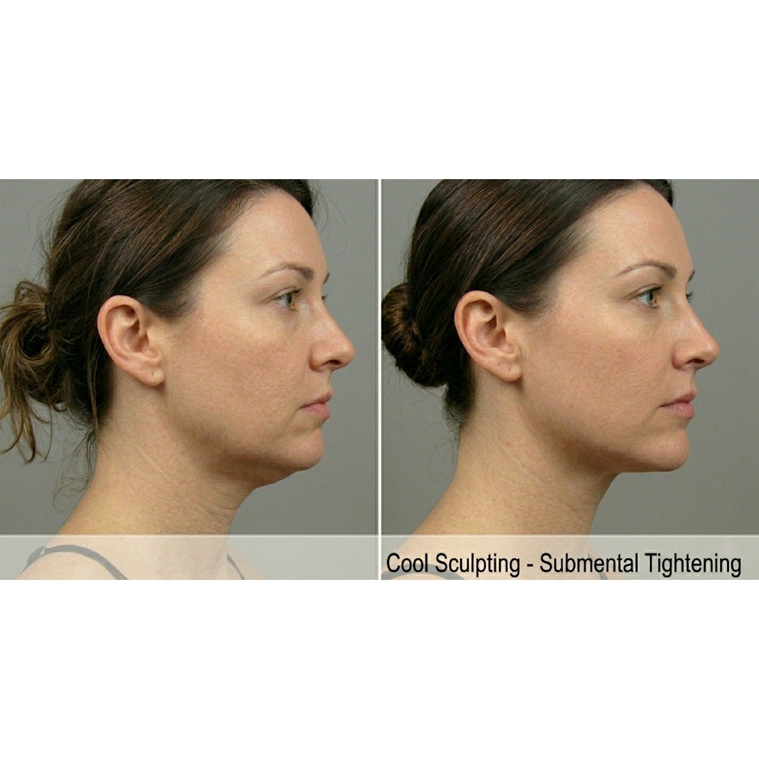 CryoShape: Cryolipolysis Machine