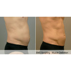 Tone Wave: EMS Body Sculpting