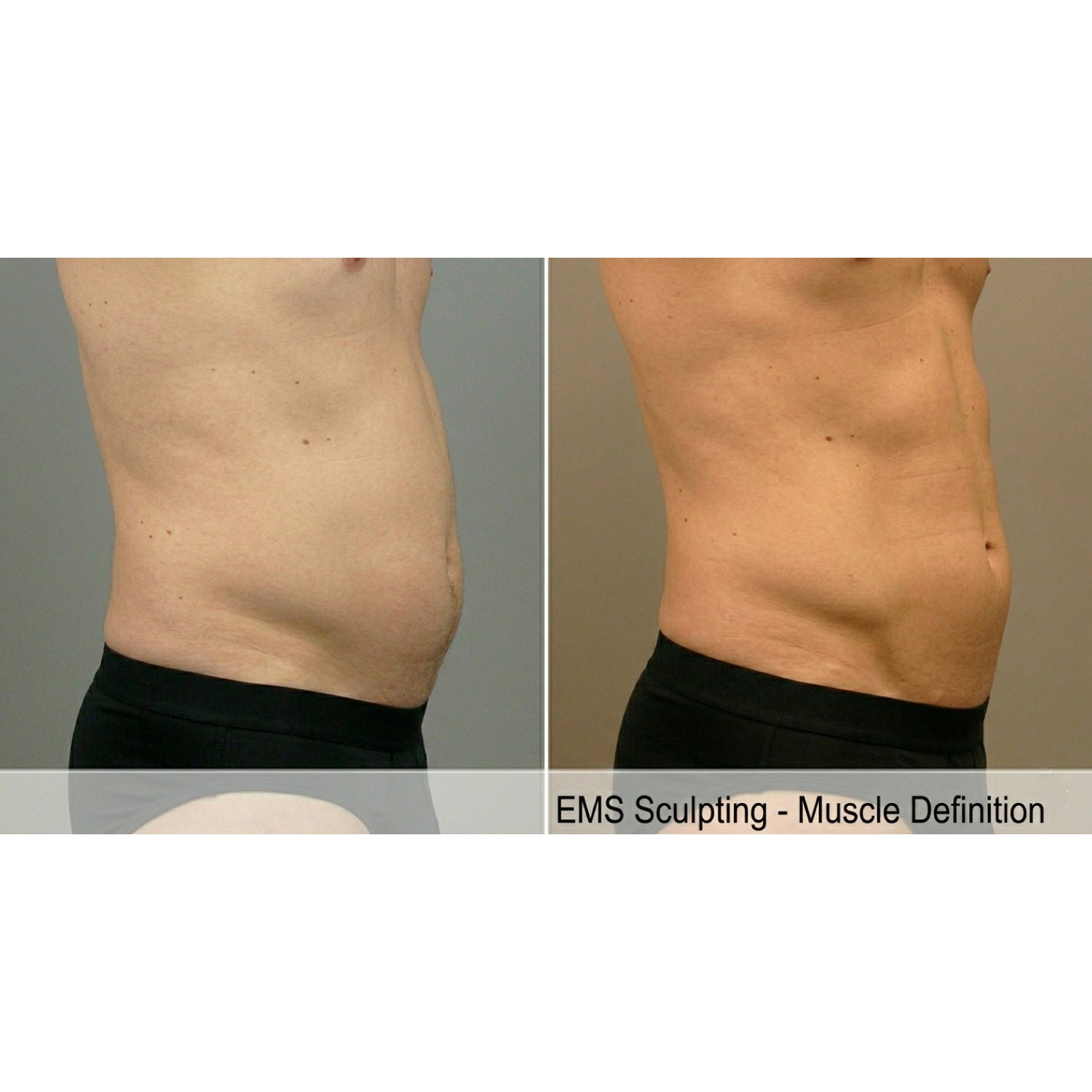 Tone Wave: EMS Body Sculpting