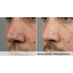 HydraGlow: Hydradermabrasion