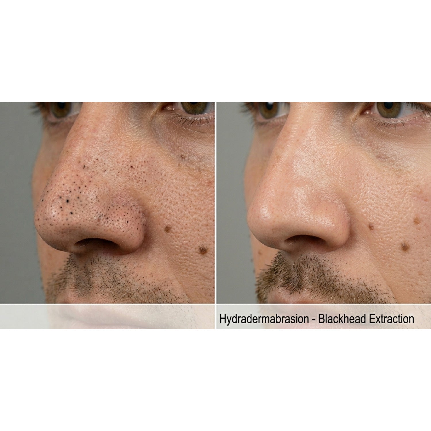 HydraGlow: Hydradermabrasion