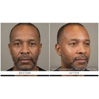 HydraGlow: Hydradermabrasion