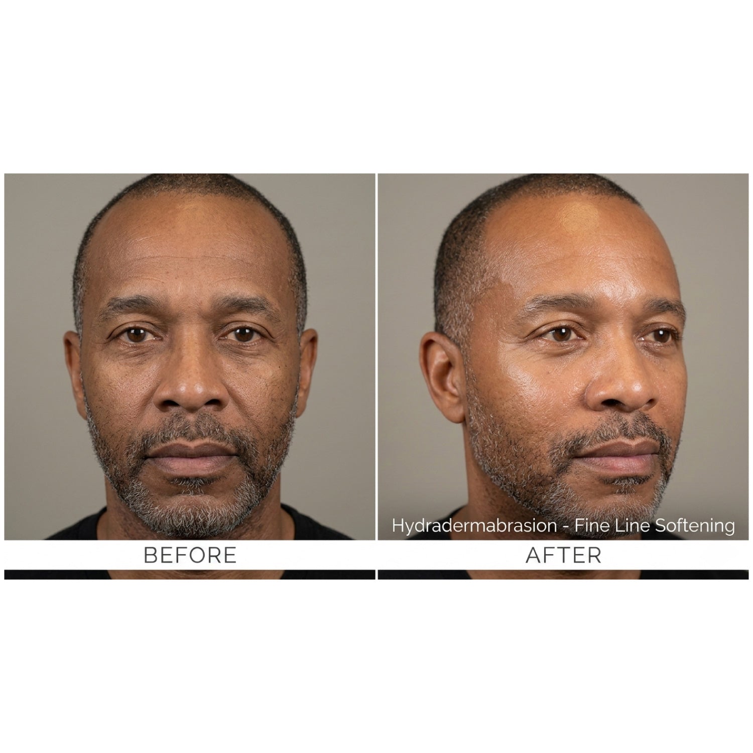 HydraGlow: Hydradermabrasion