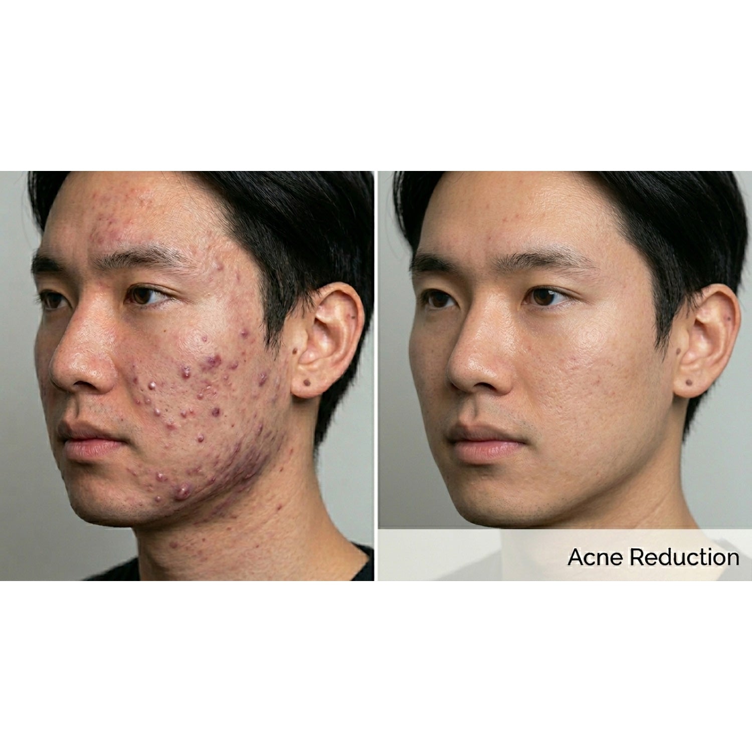 Dualis X: ND:YAG Laser