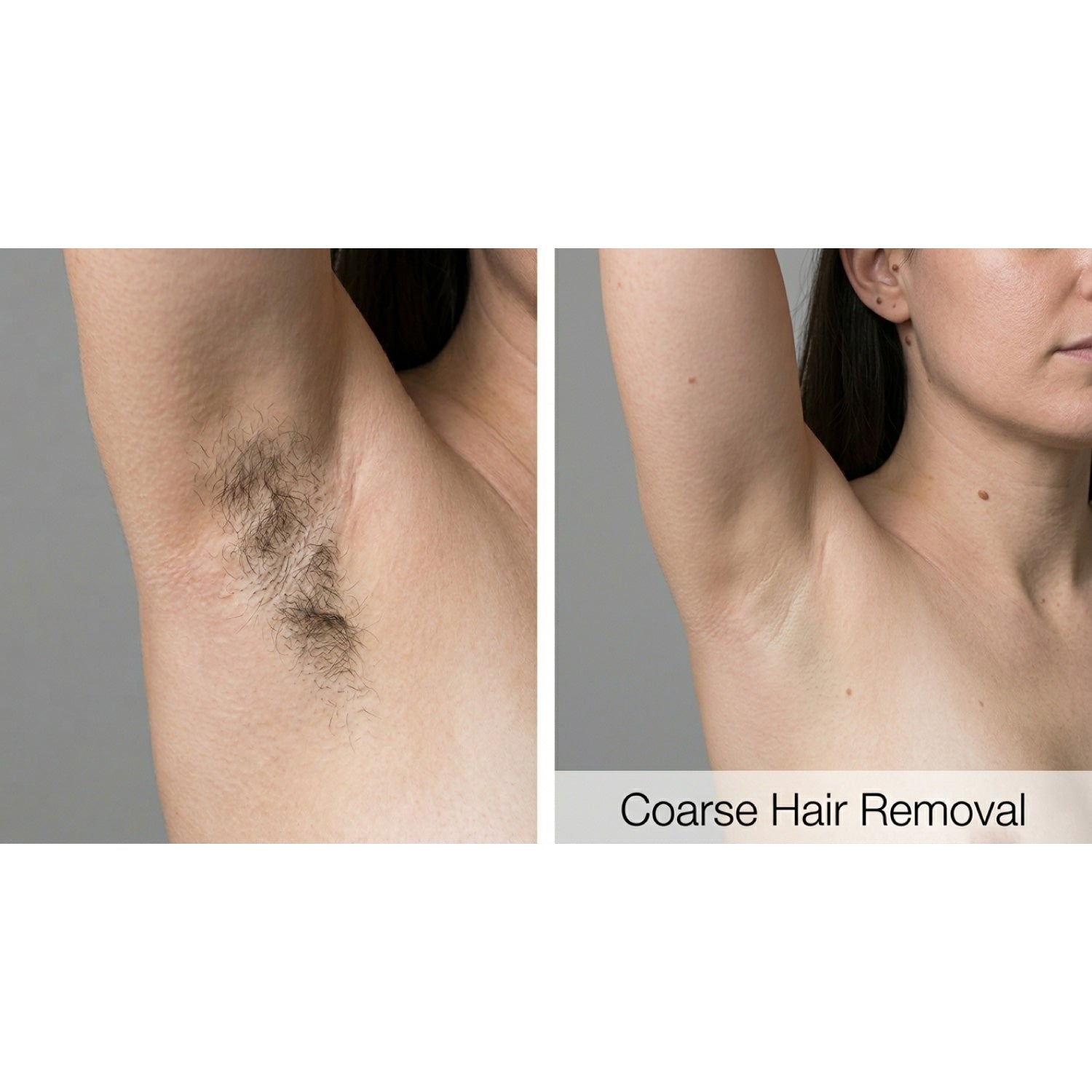 Dualis X: ND:YAG Laser