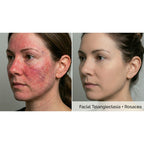 Dualis X: ND:YAG Laser