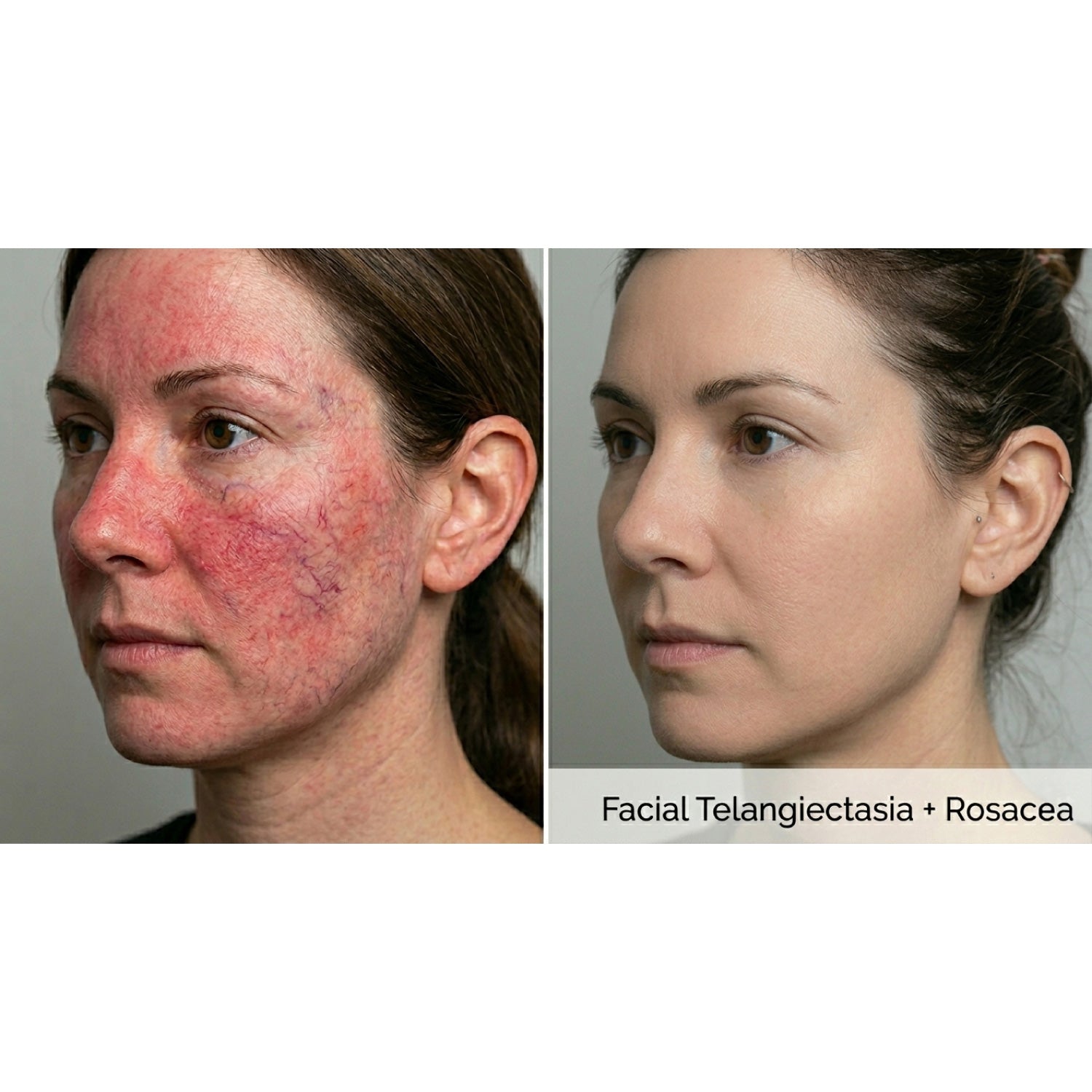 Dualis X: ND:YAG Laser