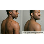 PicoPulse: Picosecond Laser