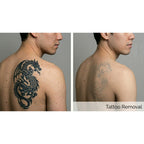 PicoPulse: Picosecond Laser