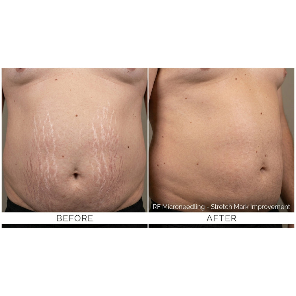 FirmX RF: RF Microneedling
