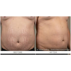 FirmX RF: RF Microneedling